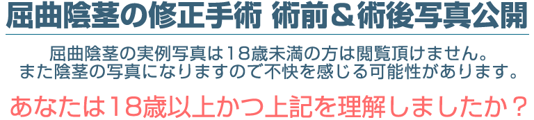 屈曲陰茎の修正手術 術前＆術後写真公開