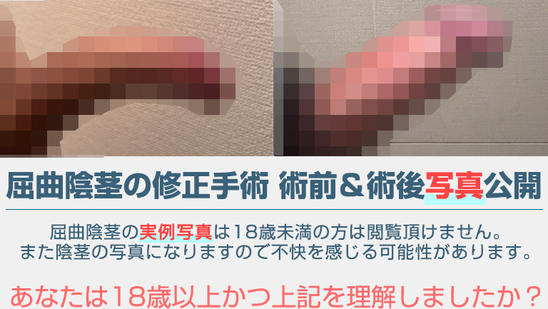 屈曲陰茎の修正手術 術前＆術後写真公開
